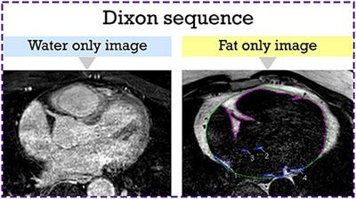 MRI-quantified left atrial epicardial adipose tissue predicts atrial fibrillation recurrence following catheter ablation